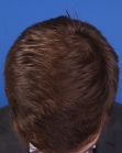 After Hair Transplant&nbsp;Front